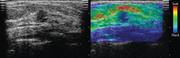 Example of strain imaging of a lobular carcinoma in situ. Left: B-mode image. Right: elastogram using strain imaging.