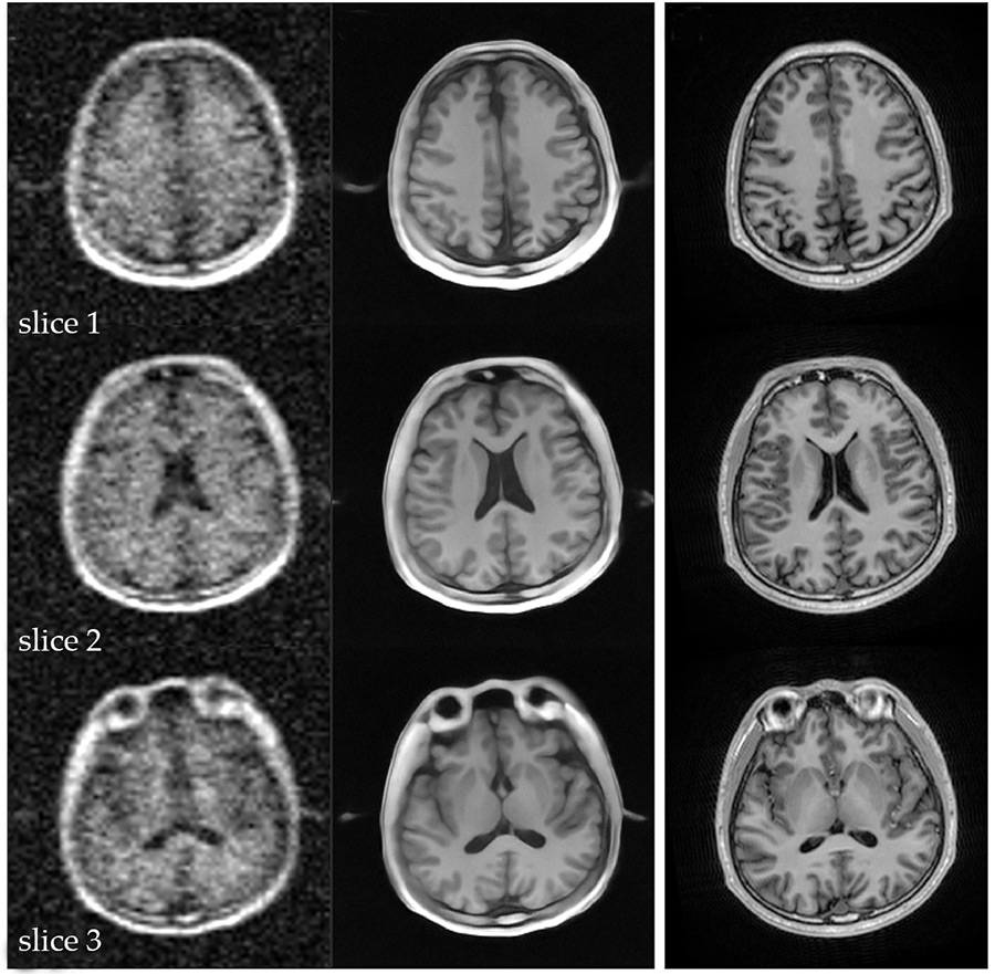 MRI images of a human brain. Blurry images in the left column were corrected with AI. The corrected images, shown in the center column, are similar to more typical MRI images, shown in the right column.