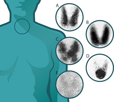 Thyroid imaging