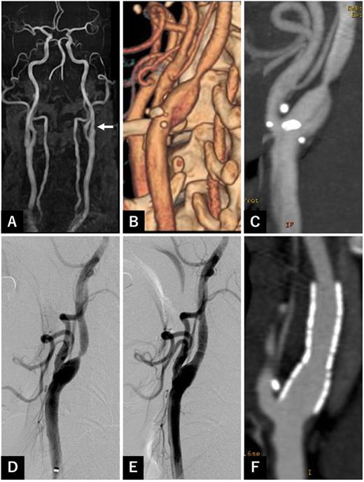 FIG. 1. Time course angiographical studies of the patient. Initial magnetic resonance angiography shows the mild stenosis of the left ICA [(a), arrow]. Follow-up computed tomography angiography 4 years after the initial examination presents worsened stenosis in the left ICA [(b) 3-dimensional reconstructed image and (c) maximum intensity projection]. The preoperative lateral view of the left common carotid angiography demonstrates 85% stenosis of the left ICA (d). The postoperative lateral view of the left common carotid angiography indicates the complete reconstruction of the carotid artery stenosis (e). The sagittal view of the reconstructed computed tomography angiography 1 year after carotid artery stenting shows no in-stent restenosis (f). ICA: internal carotid artery.