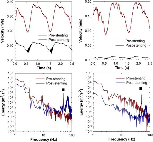 FIG. 11. Near-wall hemodynamics studied at a distance of 10 µm from the bifurcation wall (left column) and stenosis wall (right column). The top row shows velocity-time series, and the bottom row shows the kinetic energy cascade.
