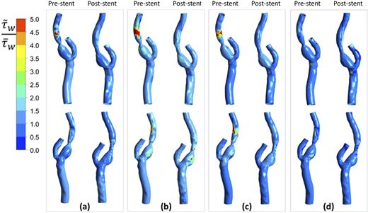 FIG. 6. Contours of normalized WSS τ̃wτ̄w (i.e., the ratio between instantaneous and time averaged WSS) before (pre) and after (post) stenting. The top row shows the front plane, and the bottom row shows the back plane. Different time instances are (a) mid acceleration, (b) peak systole, (c) mid deceleration, and (d) end diastole.