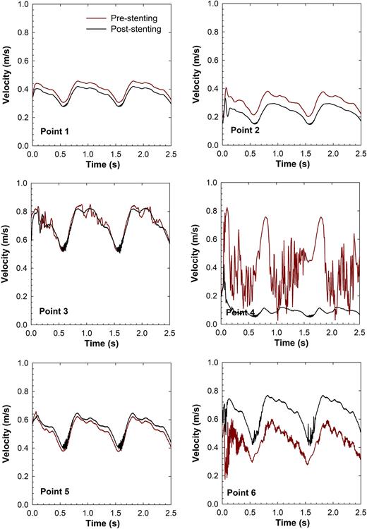 FIG. 8. Tracing local velocity time-series in pre-stenting (case 1) and post-stenting (case 2) conditions along six centerline points along the domain.