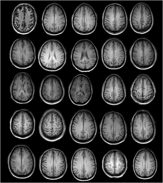 FIG. 1. MRI scans of 26 individuals with mTBI shown in the transverse plane, ordered from left to right then top to bottom, in MicroDicom (MicroDicom, v4.0.0). The transverse plane MRI for participant 24 was not available.