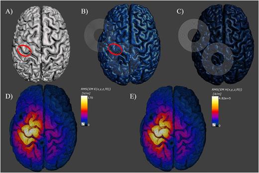 FIG. 3. (a) Gray matter in Meshmixer circling PreCG ROI. (b) Gray matter in Sim4life circling PreCG ROI. (c) Sim4life model showing coil placement over PreCG ROI. (d) Sim4life surface viewer with EFS (V/m) hotspot on gray matter. (e) Sim4life surface viewer with magnetic field (H-Field) hotspot on gray matter (A/m). White corresponds to maximum field intensity and black corresponds to zero field intensity.