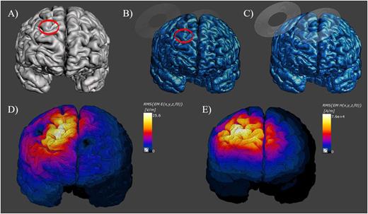FIG. 4. (a) Gray matter in Meshmixer circling DLPFC. (b) Gray matter in Sim4life circling DLPFC ROI (c) Sim4life model showing coil placement over DLPFC. (d) Sim4life surface viewer with EFS hotspot on gray matter. (e) Sim4life surface viewer with magnetic field (H-Field) hotspot on gray matter. White corresponds to maximum field intensity and black corresponds to zero field intensity.