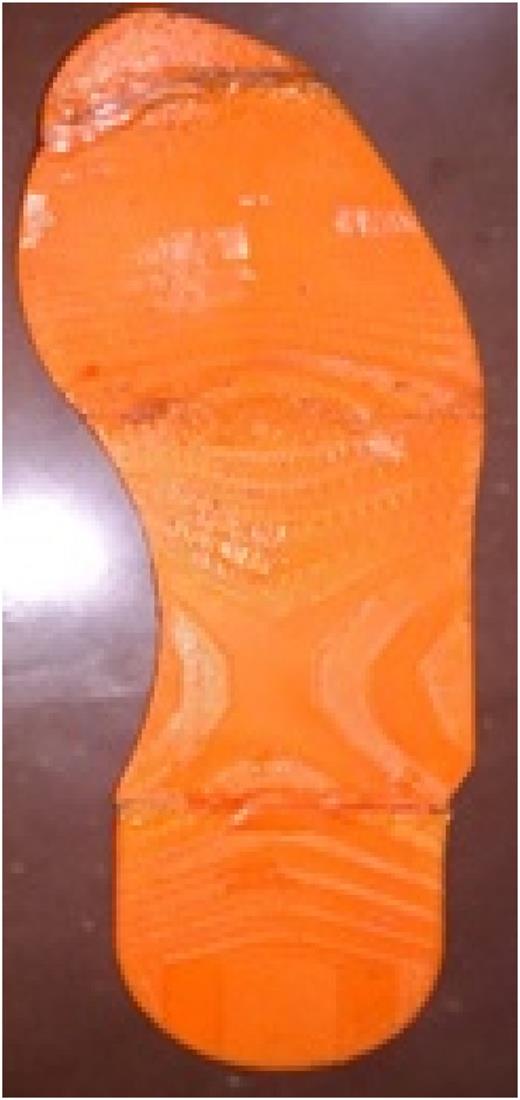 A 3D-printed template is employed to manufacture a carbon fiber footplate.