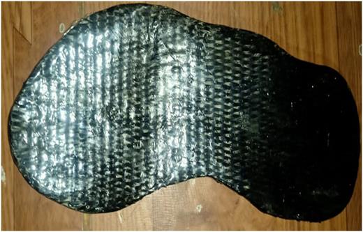 Partial foot orthosis manufactured using carbon fibers.