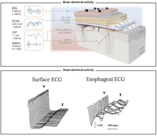 Illustration of electrode types for electrophysiological recordings of brain and heart activity. It illustrates the importance of proximity in accurately recording brain and heart electrical activity and complements Table I. The top panel displays different types of electrodes for recording brain activity. It shows that implantable and invasive sensors allow for more accurate recordings as they get closer to the brain tissue. Reproduced with permission from Cutrone et al., Adv. Healthcare Mater. 8, 1801345 (2019). Copyright 2019 John Wiley and Sons.9 Reproduced with permission from Szostak et al., Front. Neurosci. 11, 665J (2017). Copyright 2017 Authors, licensed under a Creative Commons (CC BY) license.46 The bottom panel demonstrates the importance of proximity in recording heart activity. Signals during myocardial ischemia were recorded using surface ECG (external sensor) and esophageal ECG (closer to the heart).35 It shows that signals closer to the heart are more accurate than those recorded externally. Adapted with permission from Mächler et al., Internet J. Thorac. Cardiovasc. Surg. 2, 8758 (1998). Copyright 1998 ISPUB, www.ispub.com.35