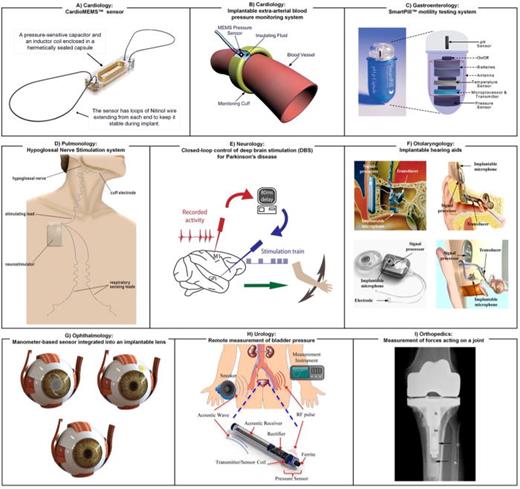 A visual representation of various applications of implanted sensors in different fields of medicine. (a) Cardiology: CardioMEMS™ sensor. Reproduced with permission Rali et al., Am. J. Case Rep. 19, 382–385 (2018). Copyright 2018 Authors, licensed under a Creative Commons (CC BY-NC-ND) license.86 (b) Cardiology: extra-arterial blood pressure (BP) measurement, a long-term arterial cuff developed at Case Western Reserve University. Reproduced with permission from Cong et al., in Proceedings of the 28th IEEE EMBS Annual International Conference, New York (IEEE, 2006), pp. 1854–1857. Copyright 2006 IEEE.87 (c) Gastroenterology: wireless motility capsule that records pH, temperature, and pressure in real-time as it traverses the digestive system. Reproduced with permission from Fernandes et al., Mater. Today. 12, 14–20 (2009). Copyright 2009 Authors, licensed under a Creative Commons (CC BY-NC-ND) license.88 (d) Pulmonology: hypoglossal nerve stimulation system with sensing properties. Reproduced with permission from Eastwood et al., Sleep 34, 1479–1486 (2011). Copyright 2011 OUP.89(e) Neurology: a scheme of how a closed-loop deep brain stimulation (DBS) system with sensing properties is designed. Reproduced with permission from Santos et al. Neuron 72, 197–198 (2011). Copyright 2011 Elsevier.90 (f) Otolaryngology: microphone technologies used for fully implantable hearing aids: top left: TICA (Implex, Munich, Germany); top right: Carina (Cochlear, Sydney, Australia); bottom left: TIKI (Cochlear, Sydney, Australia); bottom right: Esteem (Envoy, Saint Paul, MN, USA). Reproduced with permission from Woo et al., Sensors 15, 22798–22810 (2015). Copyright 2015 Authors, licensed under a Creative Commons (CC BY) license.91 (g) Ophthalmology: manometer-based sensor integrated into an implantable lens: top left: capacitive sensor measuring IOP directly; top right: resistive sensor on a contact lens; bottom: IOP, intraocular pressure. Reproduced with permission from Molaei et al., J. Ophthalmic Vis. Res. 13, 66 (2018). Copyright 2018 Authors, licensed under a Creative Commons (CC BY-NC-SA) license.92 (h) Urology: schematic of an acoustically powered transponder implanted in the bladder for remote measurement of bladder pressure. Reproduced with permission from Kim et al., IEEE Trans. Biomed. Eng. 61, 2209–2217 (2014). Copyright 2014 IEEE.93 (i) Orthopedics: postoperative radiograph of the knee joint demonstrating implantation of a second-generation instrumented tibial prosthesis that was used to measure forces acting on the joint. Reproduced with permission from D'Lima et al., J. Biomech. 40, S11–S17 (2007). Copyright 2007 Elsevier.94 The examples depicted in (g)–(i) are not directly discussed in this review. These examples were included in the figure to illustrate the diverse range of applications across various fields in medicine where implantable sensors are employed. The order of photos in this figure was intentionally arranged for visual impact rather than the textual order of mention.