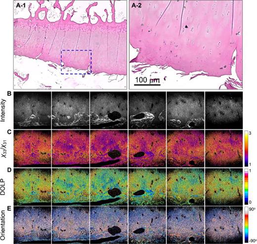 Images of OA tissue: (a-1) and (a-2) H&E-stained images, where (a-2) shows a magnified view of the region indicated in (a-1). (b)–(e) are the SHG intensity, χ33/χ31, DOLP, and planar orientation of the OA tissues, respectively. The color scale shows the values of each parameter. Image size = 400 × 400 μm2. Images (b)–(e) are representative and were selected from the samples used (n = 5).