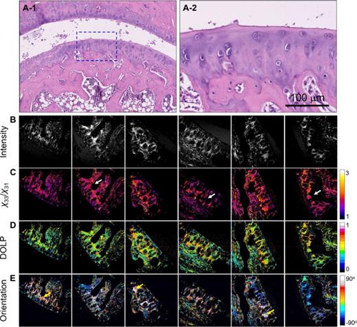 Images of RA tissue: (a-1) and (a-2) H&E-stained images, where (a-2) shows a magnified view of the region indicated in (a-1). (b)–(e) are the SHG intensity, χ33/χ31, DOLP, and planar orientation of the RA tissues, respectively. The white arrows indicate the erosion of cartilage and the swelling of chondrocyte areas, and the yellow arrows indicate areas with similar colors, showing nearly consistent fibril orientations due to the existence of type-I collagen. The color scale shows the values of each parameter. Image size = 400 × 400 μm2. Images (b)–(e) are representative and were selected from the samples used (n = 5).