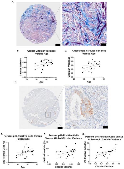 Regional matrix analysis of human interstitial pulmonary fibrosis tissue samples. (a) Representative image of Masson's trichrome stained interstitial (obj. = 40×, N.A. = 0.95, large image scale bar = 200 μm, zoom scale bar = 50 μm). (b) Simple linear regression of global circular variance vs age of pulmonary fibrosis patient (n = 2 samples per patient, N = 23 patients). (c) Simple linear regression of anisotropic circular variance vs age of pulmonary fibrosis patient (n = 2 samples per patient, N = 23 patients). (d) Representative image of p16-stained pulmonary fibrosis patient tissue sample (obj. = 40×, N.A. = 0.95, large image scale bar = 200 μm, zoom scale bar = 20 μm). (e) Simple linear regression of percent of p16-positive cells vs age of pulmonary fibrosis patient (n = 2 samples per patient, N = 23 patients). (f) Simple linear regression of percent of p16-positive cells vs global circular variance of pulmonary fibrosis patient (n = 2 samples per patient, N = 23 patients). (g) Simple linear regression of percent of p16-positive cells vs anisotropic circular variance of pulmonary fibrosis patient (n = 2 samples per patient, N = 23 patients). Simple linear regression. *P ≤ 0.05, **P ≤ 0.01, ***P ≤ 0.001, ****P ≤ 0.0001.