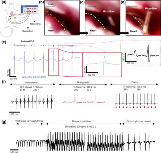 Cardiac application of the fiber in terms of recording and electroceutical functionality. (a) Schematic illustration demonstrating the setup of an in vivo rat model experiment, highlighting simultaneous electrogram recording and electrical stimulation. Optical endoscope image captured during minimally invasive fiber implantation: (b) before implantation, (c) during implantation, and (d) showing secure contact with the heart. (e) Comparison of the recorded epicardial electrogram's intensity with skin ECG. (f) Epicardial electrograms of normal heart, bradycardia, and during pacing. (g) Epicardial electrogram during ventricular tachycardia, resynchronization therapy, and post recovery.