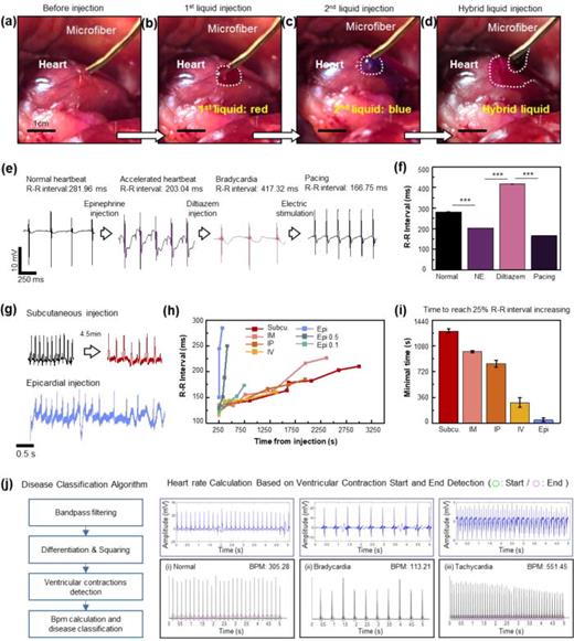 In vivo demonstration of drug delivery and performance evaluation. (a) Optical image of the drug administration process: before injection, (b) during first type of drug injection, (c) the second type of drug injection, and (d) the combined type of drug injection. (e) Transitions of the epicardial electrogram observed during sequential delivery of epinephrine, diltiazem and electrical signals. (f) Comparison of the R–R interval between normal and after administration of epinephrine, diltiazem, and electrical stimulation. (g) Instantaneous heart rate changes compared to subcutaneous injection. (h) Transition of the R–R interval over time following injection, based on the injection method. (i) Comparison of response times based on the injection method. The response time is defined as the point when the R–R interval increases to 125% of its baseline value. (j) Disease classification code (MATLAB) and the result when applied to normal, bradycardia, and tachycardia electrogram. By detecting the number of ventricular contractions, the code can accurately classify the manifestation of the arrythmia.