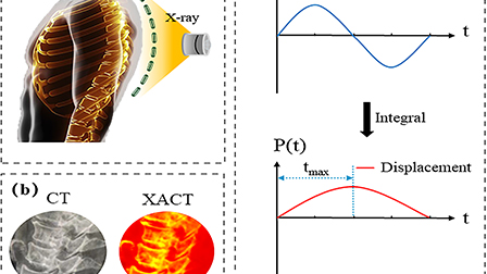 Mechanical characterization of osteoporosis based on x-ray induced