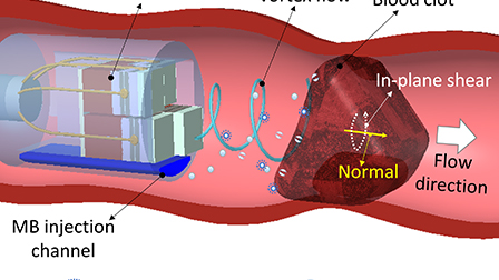 Vortex-ultrasound for microbubble-mediated thrombolysis of retracted ...