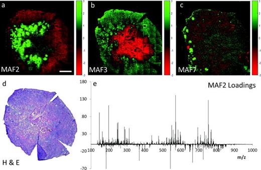 Fig. 3. MAF scores images [(a)–(c)] from positive ion data from patient #7 following removal of signal from outside the tissue. Positive scoring pixels are colored green and negative scoring pixels are colored red. Dark/black pixels are those showing little variance on the specific factor. MAF2 shows normal (green) vs cancerous (red) tissue (a), MAF3 highlights a mixture of scar tissue and subcutaneous fat (red) (b), while the epidermis and hair follicles are shown in green in MAF7 (c). H &amp; E-stained image of a consecutive tissue slice where the deeper purple areas are generally associated with cancer (d) and loadings for MAF2 where the negative loading peaks are associated with the cancerous tissue (e). SIMS image size 9600 × 9600 μm2, scale bar = 1600 μm.