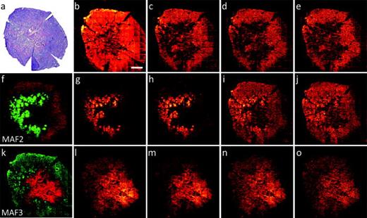 Fig. 4. H &amp; E image of a consecutive slice of the tissue sample analyzed using SIMS from patient #7 (a). Single ion images of the four most strongly negative loading (red) peaks in MAF2 associated with the cancerous parts of the tissue, m/z 184.07, 542.50, 666.48, and 725.55 [(b)–(e), respectively]. Scores image of MAF2 (f) and single ion images most strongly positive loading (green) peaks in MAF2 correlated with the normal tissue, particularly the sebaceous glands, m/z 571.48, 754.54, 198.09 and 146.98 [(g)–(j), respectively]. Scores image of MAF3 (k), Single ion images of the four most strongly negative loading (red) peaks in MAF3 corresponding to fibrotic stroma and fat tissue, m/z 577.52, 603.53, 575.50, and 601.52 [(l)–(o), respectively]. SIMS image size 9600 × 9600 μm2, scale bar = 1600 μm.