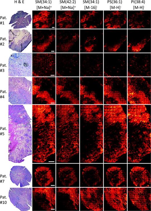 Fig. 5. H &amp; E-stained images and single ion images of SM(34:1) and SM(42:2) [M+Na]+ ions at m/z 725. 55 and m/z 835.65, respectively, and the corresponding SM(34:1) negative ion fragment along with the [M−H]− ions of PS(36:1) and PI(38:4) at m/z 687.54, 788.54, and 885.55, respectively, from six different patients exhibiting aggressive BCC pathology. Scale bars = 1600 μm. Data shown from patients #1–5, #7, and #10.