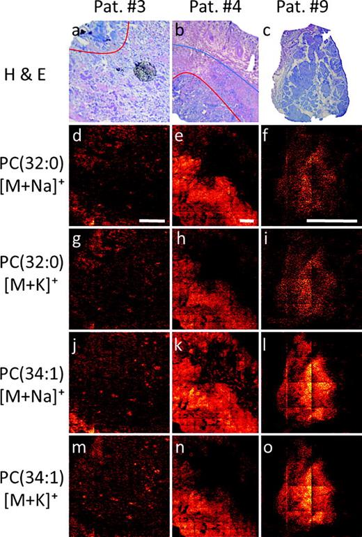 Fig. 6. Comparison of more and less aggressive tumor signals from mixed cancer type samples (patients #3 and #4) and a punch biopsy of a nodular less aggressive lesion (patient #9). The boarder of the aggressive and highly aggressive tumor growth in the H &amp; E stained images of patients #3 and #4 is indicated by red lines [(a) and (b)] while demarcation of the aggressive tumor region and the normal tissue is provided by a blue line (b). Ion images of the [M+Na]+ and [M+K]+ ions of PC(32:0) (m/z 756 and 772, respectively) and PC(34:1) (m/z 782 and 798, respectively) are shown. Scale bars are 1600 μm in all cases.