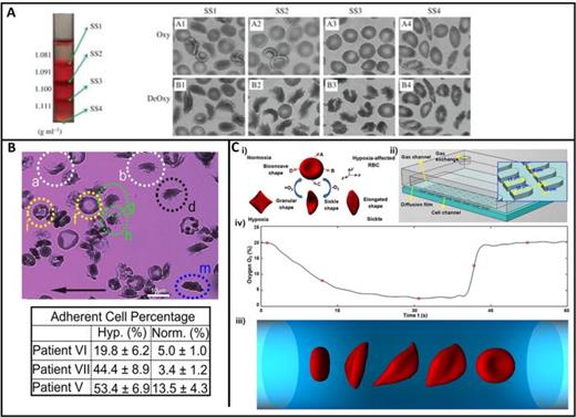 Cardiovascular consequences of sickle cell disease | Biophysics Reviews ...