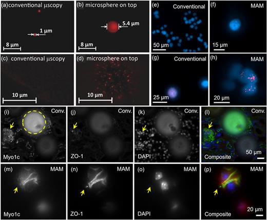 (a) Conventional FL microscopy and (b) FL MAM of a 1-μm-diameter FL bead. (c) Conventional FL microscopy and (d) FL MAM of 100-nm-diameter FL beads. Reproduced with permission from Yang et al., Small 10(9), 1712–1718 (2014). Copyright 2014 Wiley-VCH GmbH.30 U87 glioblastoma cells imaged by a 20× (NA = 0.4) objective lens under excitation at 365 nm with filtering out 440 nm for (e) conventional FL microscopy and (f) MAM through a BTG sphere (D = 130 μm and np ∼ 2.1) immersed in PDMS and DAPI. FL microscopy under excitations at 365 and 594 nm with filtering out 440 and 620 nm, respectively, for imaging cell nuclei and radiation-induced γ-H2AX foci (g) without and (h) with using the microsphere. Double-strand DNA breaks, manifested as red foci, are seen through the sphere in (h). Microscope objective was focused on the virtual images formed underneath the sphere in (f) and (h).27 Conventional FL micrographs of glomeruli stained for (i) Myo1c, (j) ZO-1, and (k) DAPI (arrows), (l) composite image of (i)–(k). MAM of glomeruli stained for (m) Myo1c, (n) ZO-1, and (o) DAPI, respectively, using a 80-μm-diameter BTG microsphere (np ∼ 2.1), and (p) the composite image of (m)–(o). Reproduced with permission from Darafsheh et al., SPIE Newsroom 29 April 2015. Copyright 2015 SPIE.29