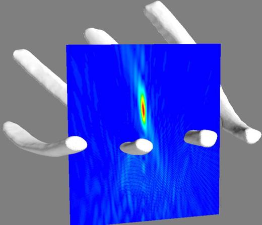 FIG. 2. (Color online) The pressure of the 1 MHz HIFU field focused inside a ribcage, computed with the fast BEM algorithm that uses OSRC preconditioning and H-matrix compression. The transducer array is located below the ribcage.