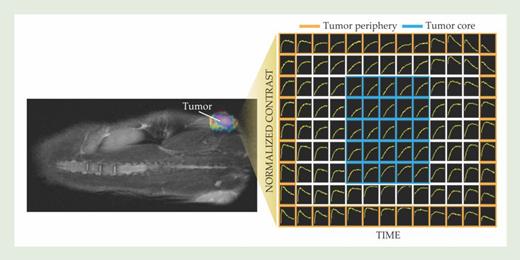 . Figure 2. A mouse implanted with a tumor was injected with a small-molecule (non-nanoparticle) contrast agent. The grid on the right shows pixel-by-pixel plots of the contrast over a 45-minute period. The molecule quickly penetrates the tumor periphery and quickly washes out. It takes longer to diffuse to the core, but the small molecule eventually washes out of the core as well. (Courtesy of Marcelino Bernardo and Lilia Ileva.)