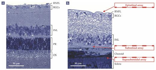 Figure 2. Retinal tissue, for better and worse. (a) A histological cross section shows the layers of a healthy rat retina. Absorption of light (incident from the top) by the outer segments (OS) of photoreceptor cells (PR) at the back of the retina generates electrical and chemical signals that are processed by the neurons of the inner nuclear layer (INL) and by the retinal ganglion cells (RGCs). The RGCs generate spike-like signals known as action potentials that propagate via the retinal nerve-fiber layer (RNFL) to the brain. (b) In a rat with retinal degeneration, the photoreceptor cells have all but wasted away. Vision can be partially restored by introducing electrode arrays on top of the nerve-fiber layer (epiretinal array), below the inner nuclear layer (subretinal array), or between the underlying choroid and sclera layers (suprachoroidal array). (Adapted from G. A. Goetz, D. V. Palanker, Rep. Prog. Phys. 79, 096701, 2016.)