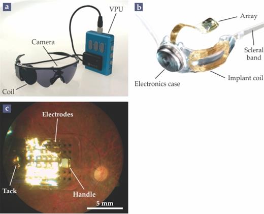 Figure 3. The Argus II. (a) The external components of the Argus II epiretinal prosthesis system include a goggles-mounted video camera, a video processing unit (VPU) that converts the camera’s images into a sequence of AC signals, and an RF coil that inductively transmits those signals to the implant. (b) The implant, affixed to the outside of the eye with a silicone band, receives the signal at an implant coil, processes the signal with onboard electronics, and then transmits it to a 6 × 10 retinal electrode array. (c) An implanted array, secured to the retina with a retinal tack. The surgeon uses the white handle to position the device in the eye. (Adapted from ref. 3, M. S. Humayun et al.)