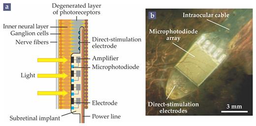 Figure 4. The Alpha IMS. In the subretinal Alpha IMS implant, powered via inductive coils, a camera and electrode array is inserted behind the retina, in the place of the eye’s degenerated photoreceptors. (a) Each pixel in the array contains a microphotodiode that converts light to electric current, an amplifier, and an electrode that stimulates neurons in the inner neural layer. Effectively, the device takes the place of the eye’s degenerate photoreceptors. The Alpha IMS also contains direct-stimulation electrodes, which can be manipulated by an external controller even in the absence of a light stimulus. (b) The implant as imaged through a patient’s pupil. (Adapted from ref. 5, CC by 3.0.)
