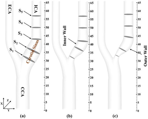 Geometry of (a) healthy, (b) 30% stenosis, and (c) 50% stenosis carotid artery (axial distance is shown in millimeters).