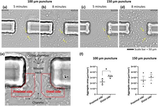In vitro flow-based aggregation assay. (a) and (b) Microscopic images of wound neck area in a 100 μm puncture size flow chamber after 5 and 8 min of blood perfusion, respectively. (c) and (d) Microscopic images of wound neck area in a 150 μm puncture size flow chamber after 5 and 8 min of blood perfusion, respectively. The yellow arrows point to stagnant RBCs in (a) and (c) and to large platelet aggregates in (b) and (d). (e) Layout sketch on top of microscopic images to visualize the orientation of the images (a)–(d) and the quantification regions (in red) at the edge of the proximal and distal sides of the wound neck facing the vessel, respectively. (f) Quantified surface coverage of platelet aggregates obtained after 8 min of perfusion at an initial wall shear rate of 400 s−1. The bars indicate the mean ± standard error of mean (SEM) aggregate area coverage in the proximal and distal regions for the 100 μm and the 150 μm puncture diameter flow chambers performed with four and three different blood donors, respectively. The results were compared by the Mann–Whitney U test (E), *p < 0.05.